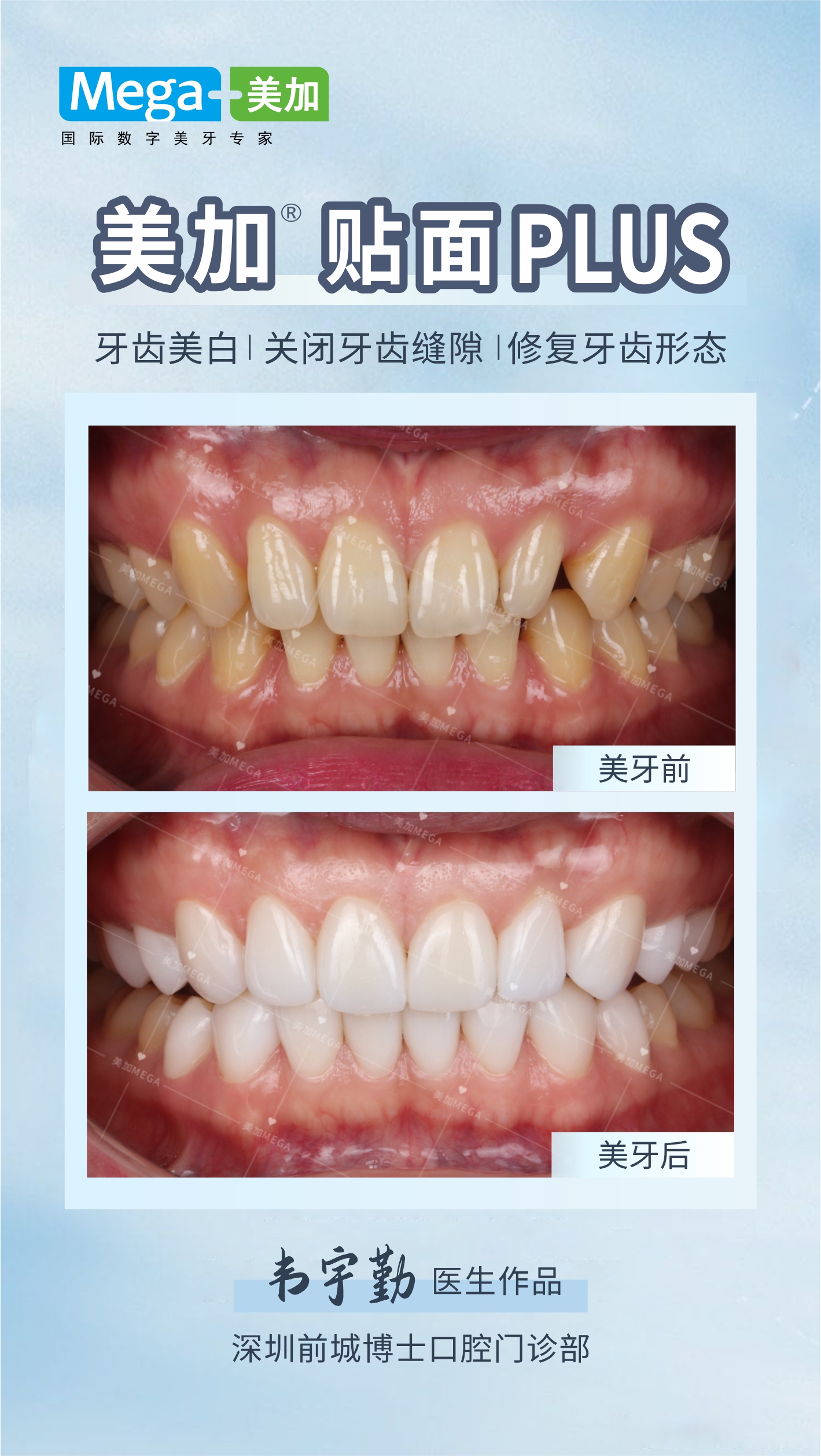 美加贴面plus-深圳前城博士口腔门诊部