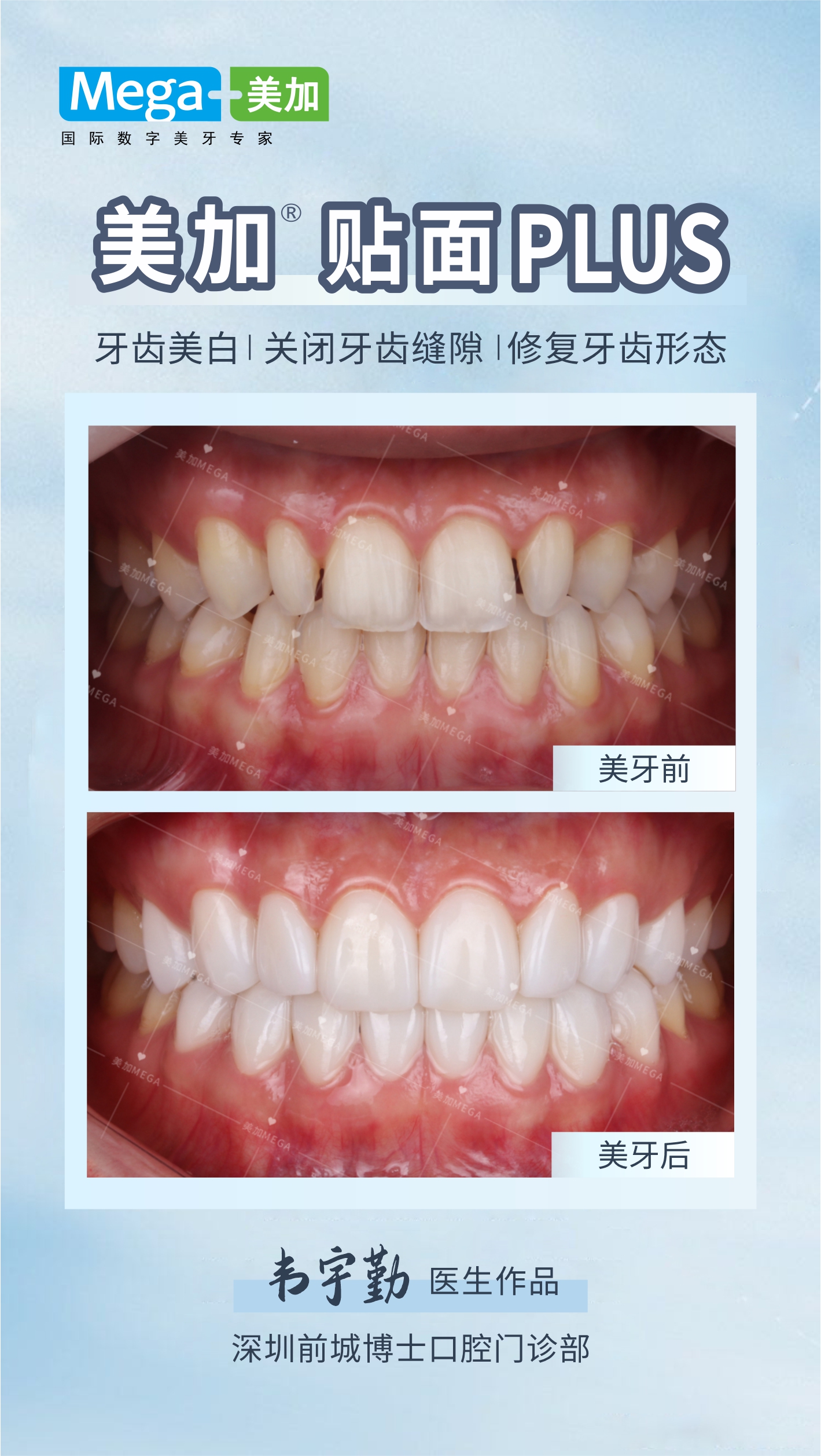 美加贴面plus-关闭牙齿缝隙