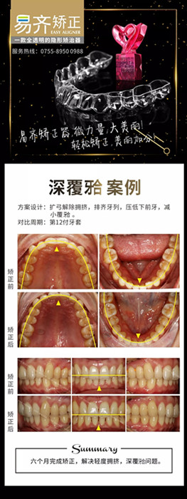 牙齿矫正对比图