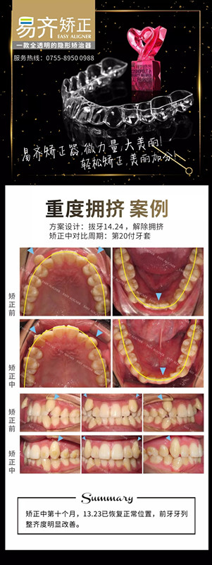 牙齿矫正对比图