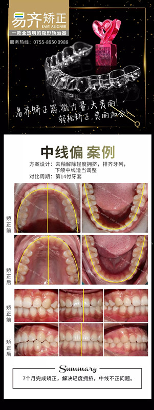 牙齿矫正案例