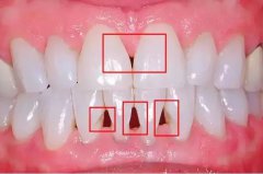 易齐矫正案例分享：关闭这种牙缝隙 建议矫正和贴面相结合！