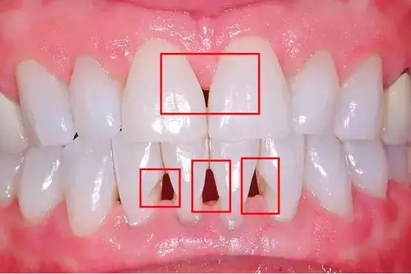易齐矫正案例分享：关闭这种牙缝隙 建议矫正和贴面相结合