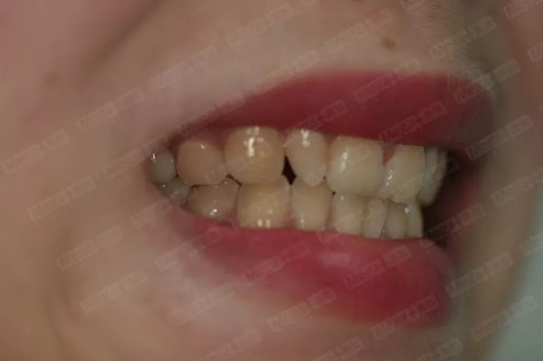 美加超薄美牙贴面案例分享：术前嘴唇图