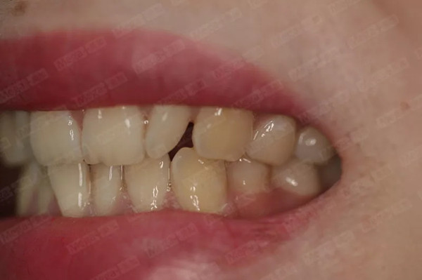 美加超薄美牙贴面案例分享：术前嘴唇图