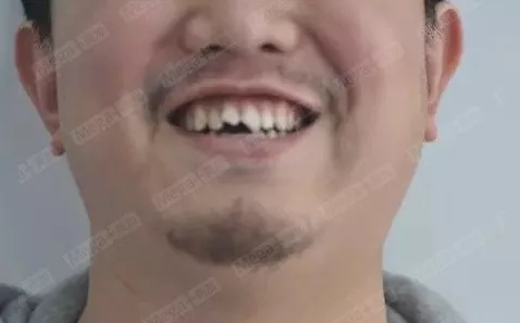 美加案例丨牙齿缺损，美加瓷贴面修复案例一则