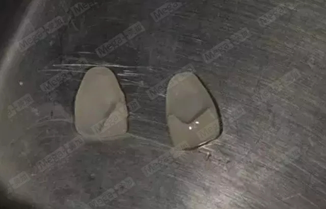 美加案例丨牙齿缺损，美加瓷贴面修复案例一则