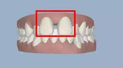 牙缝大是怎么回事呢