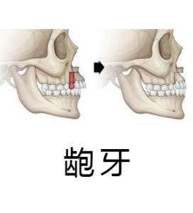 龅牙矫正有几种方法