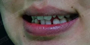 美加贴面案例：瓷贴面修复牙形态不佳