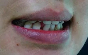 美加贴面案例：瓷贴面修复牙形态不佳