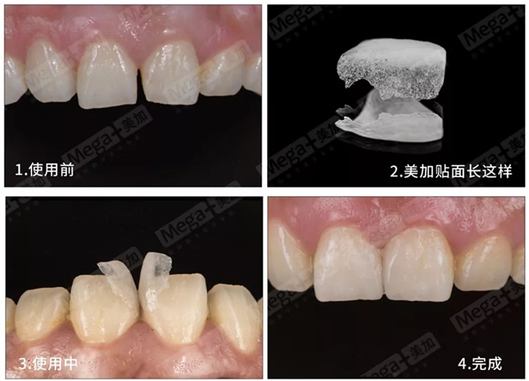 美加超薄美牙贴面
