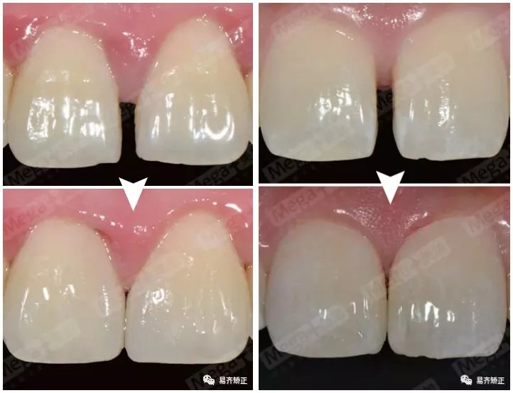 美加超薄美牙贴面关闭牙缝案例