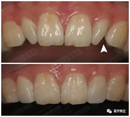 美加超薄美牙贴面关闭牙缝案例