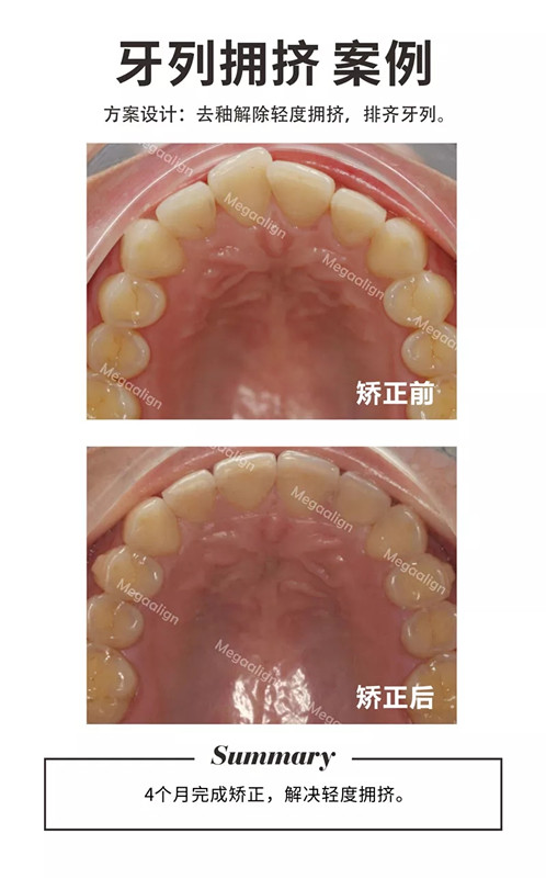 易齐微矫正牙列拥挤案例