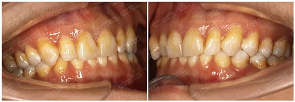 美加牙贴面氟斑牙案例-术前侧面照
