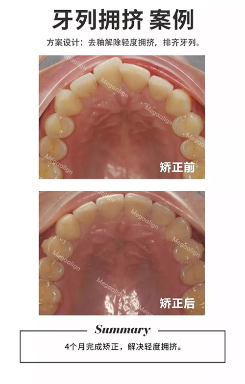 隐形矫正案例：前牙轻度扭转，易齐矫正四个月可排齐