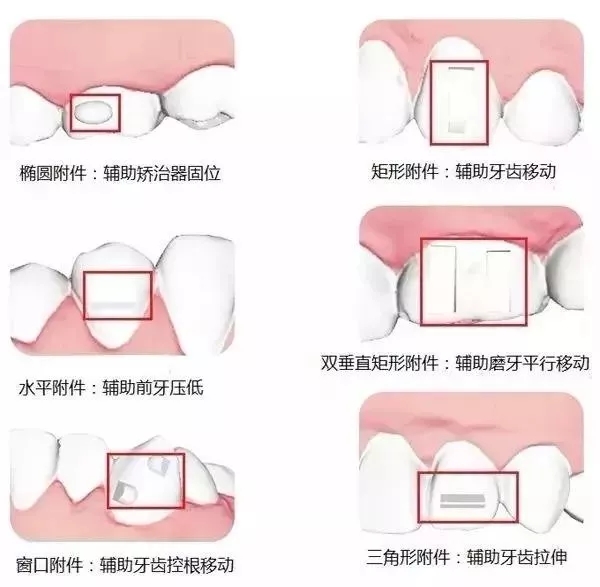 一分钟了解透明牙套的隐形矫正原理！