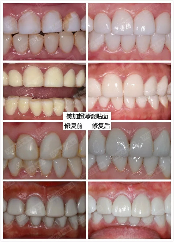 树脂贴面更换美加超薄瓷贴面修复前后对比图