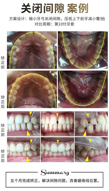 易齐透明矫正案例