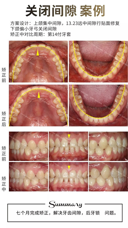易齐透明矫正案例