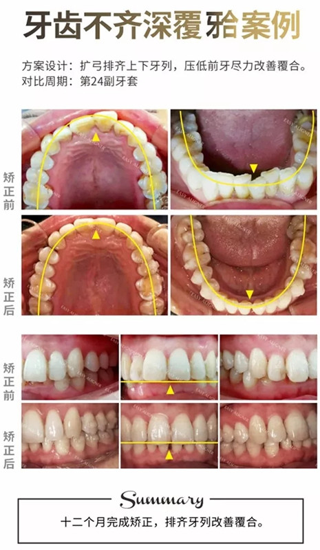 易齐透明矫正案例