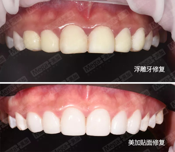 浮雕牙与美加全瓷贴面修复对比图