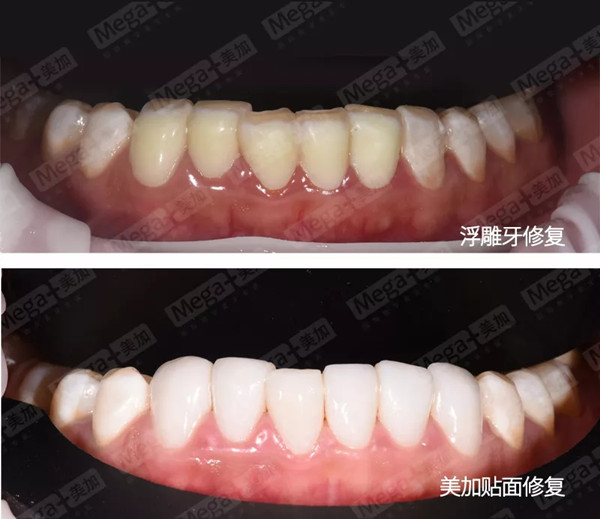 浮雕牙与美加全瓷贴面修复对比图