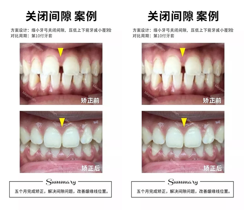 微矫正案例