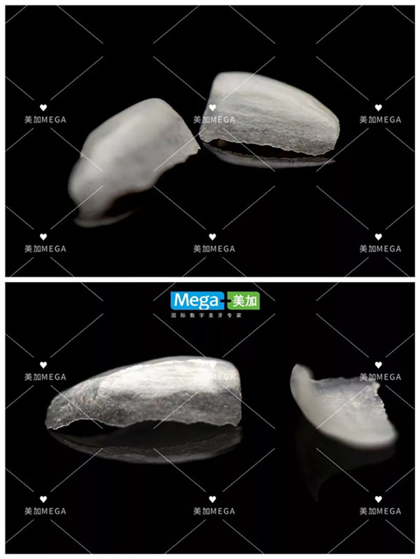美加超薄瓷贴面