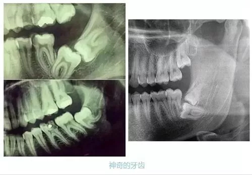 藏在牙槽骨内的智齿