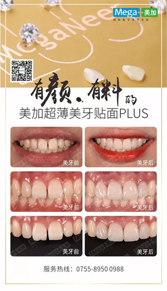 美加贴面plus美牙案例展示，揭秘高端美齿之选