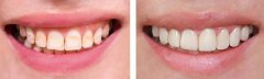美加美牙贴面修复后告诉你，氟斑牙就是这么轻松变白！