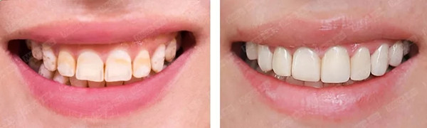 氟斑牙修复案例 1