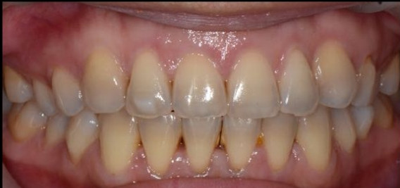 四环素牙齿能美白吗