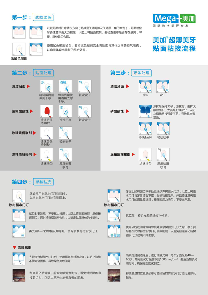 全瓷贴面粘接