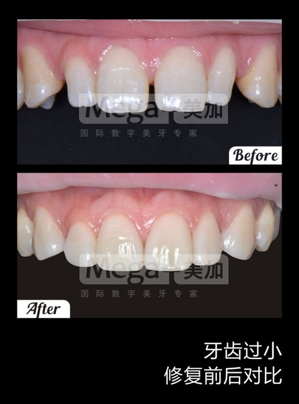 有两颗牙齿小可以做牙贴面吗