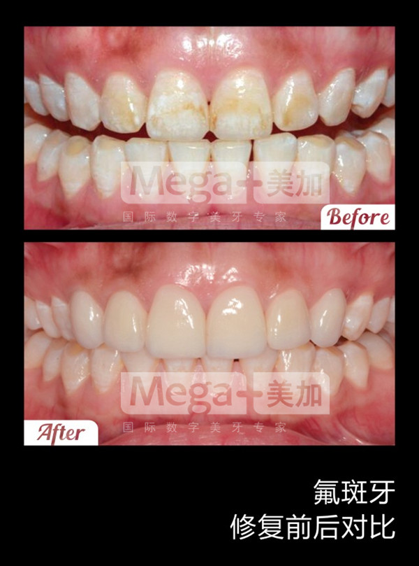 美加贴面修复氟斑牙案例