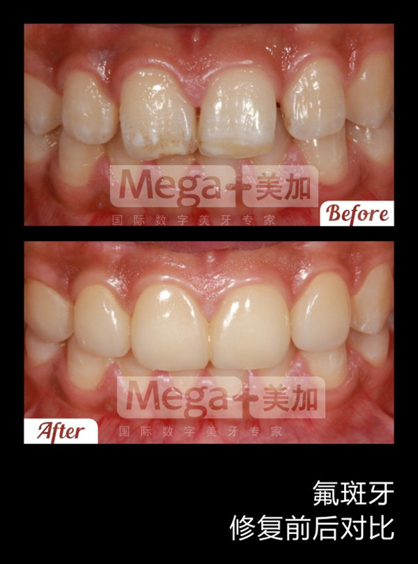 美加贴面修复氟斑牙案例