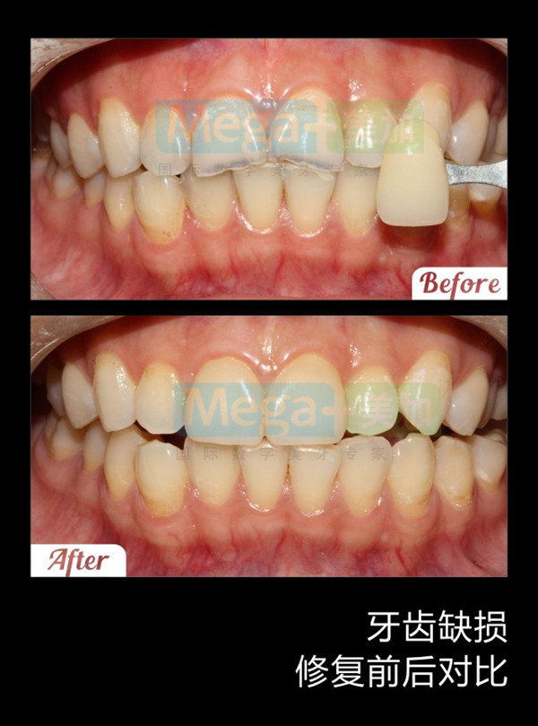 牙齿磕损可以做牙贴面吗