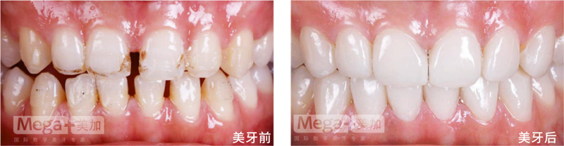 牙齿缝隙大做牙贴面好吗