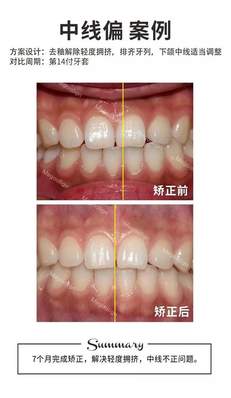 矫正牙齿前后对比图