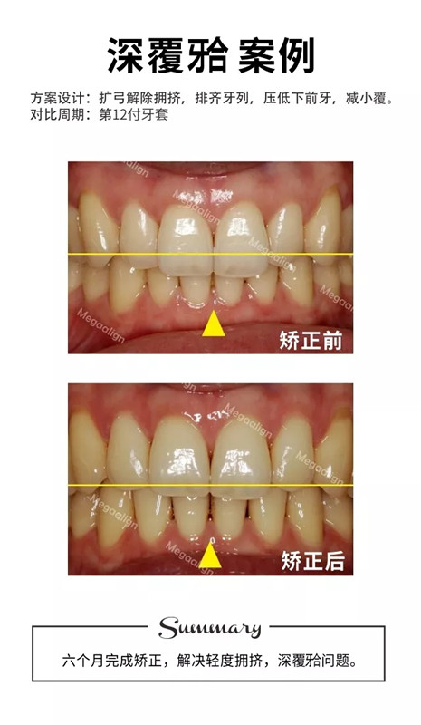 矫正牙齿前后对比图