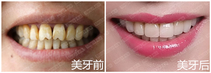 牙齿美白对比图