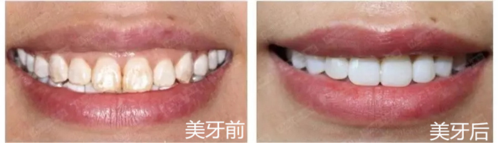 牙齿美白对比图
