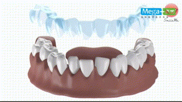 反复摘戴牙套，会造成牙齿松动吗？