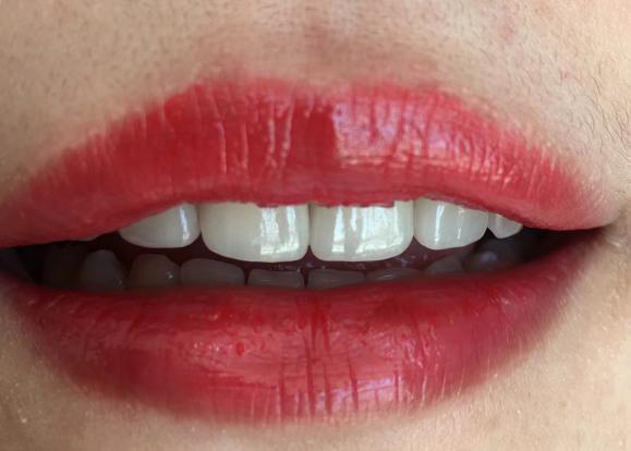 牙齿稀疏可以做牙贴面修复吗