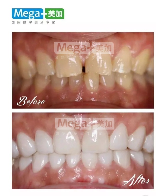 美加超薄瓷贴面关门牙缝案例
