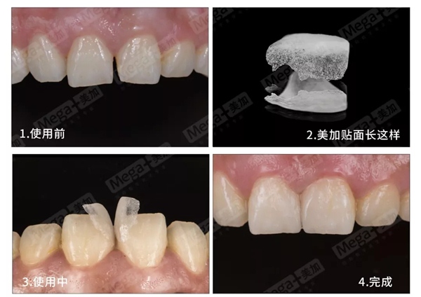 超薄瓷贴面效果图