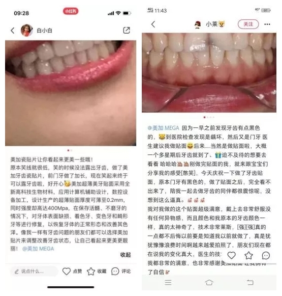 小红书上小姐姐在种草美加贴面